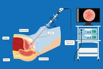 Laser Surgery