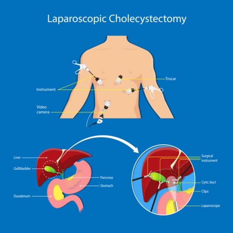Laparoscopy